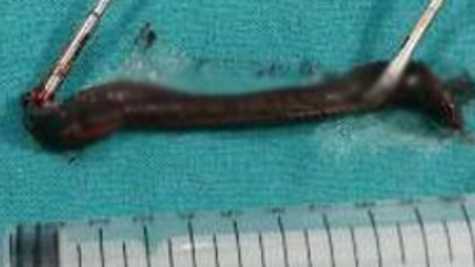 Gırtlağından canlı sülük çıkarıldı!