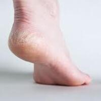 Topuk çatlaklarına dikkat