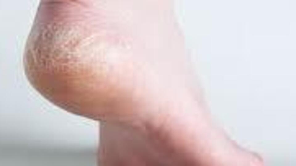 Topuk çatlaklarına dikkat