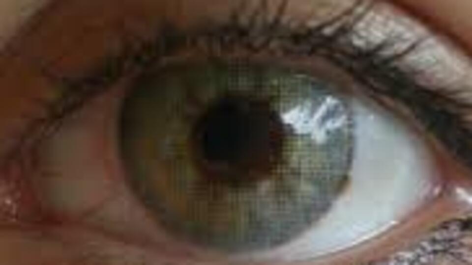 Bu hastalıkta gözler yeşile dönüyor!