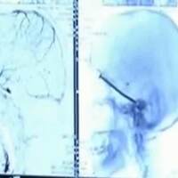 Kafasına saplandı haberi olmadı