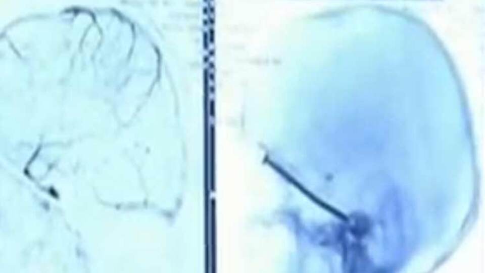 Kafasına saplandı haberi olmadı