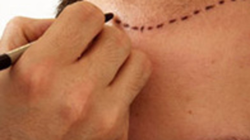 Saç ektirmeyi düşünenler dikkat!