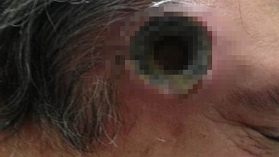 Şakağında 2.5 santimlik delik oluştu