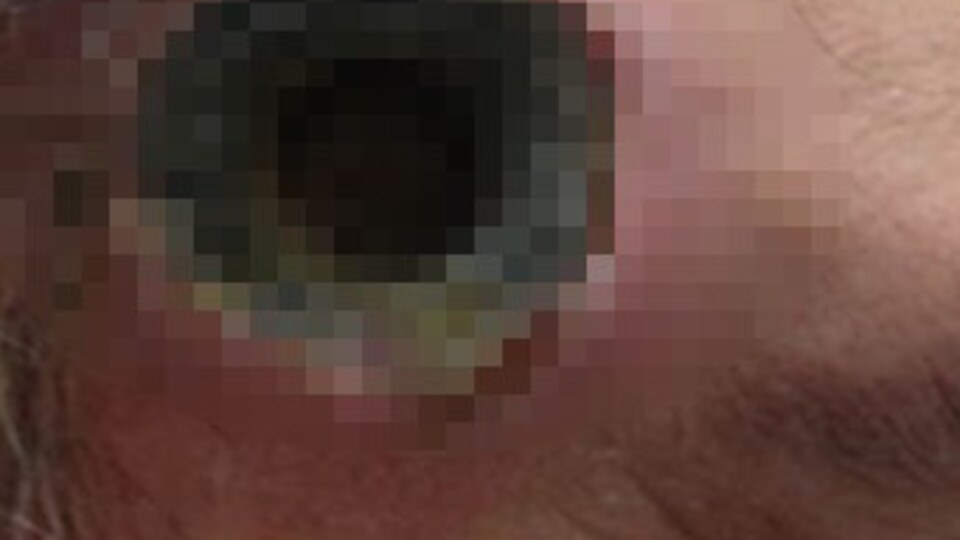 Şakağında 2.5 santimlik delik oluştu