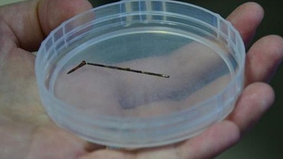 Akciğerinden iğne çıkarıldı