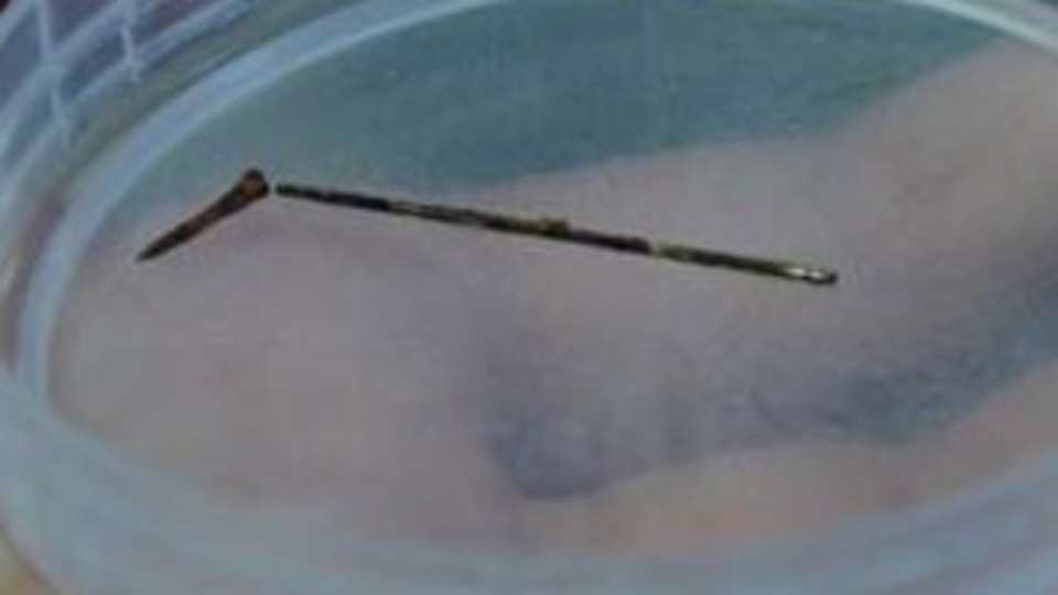 Akciğerinden iğne çıkarıldı