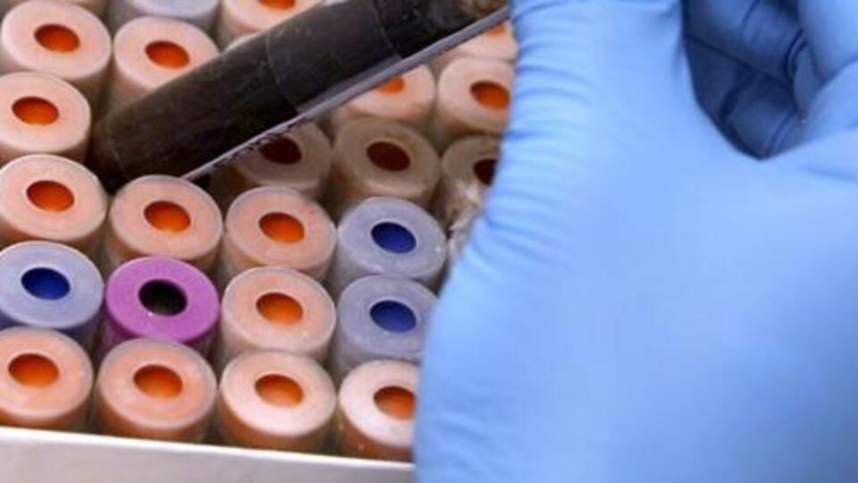 Kan testiyle Alzheimer teşhisi