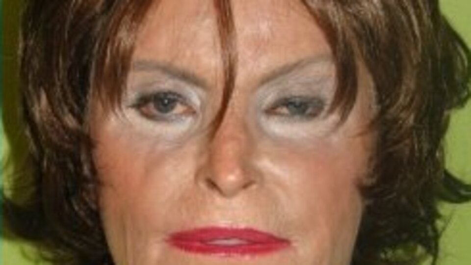 60 yıl sonra yüzündeki izlerden kurtuldu