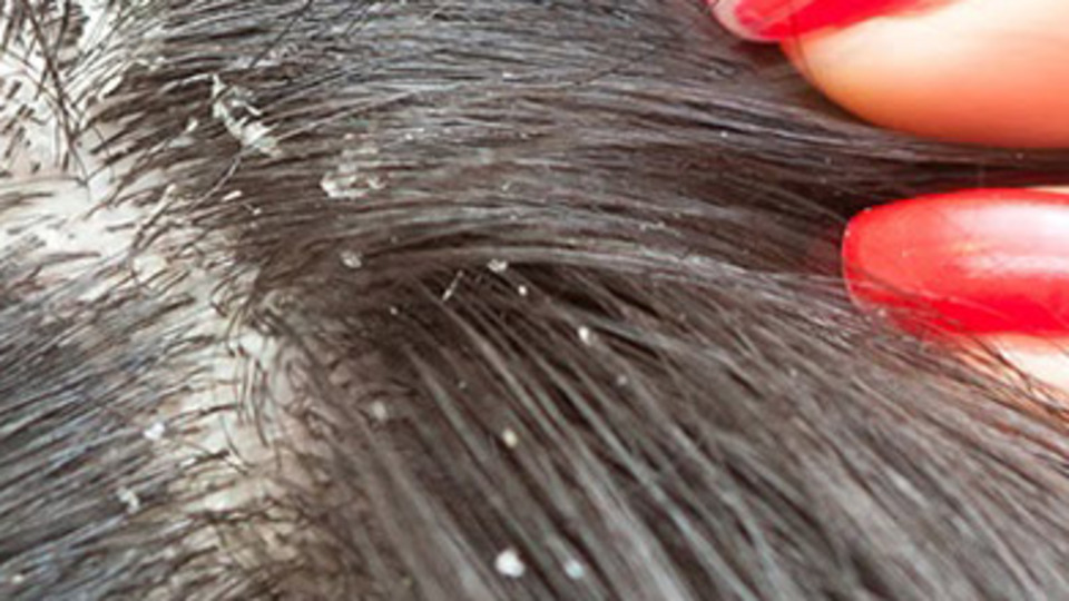 Kepeklenme hastalık göstergesi mi?