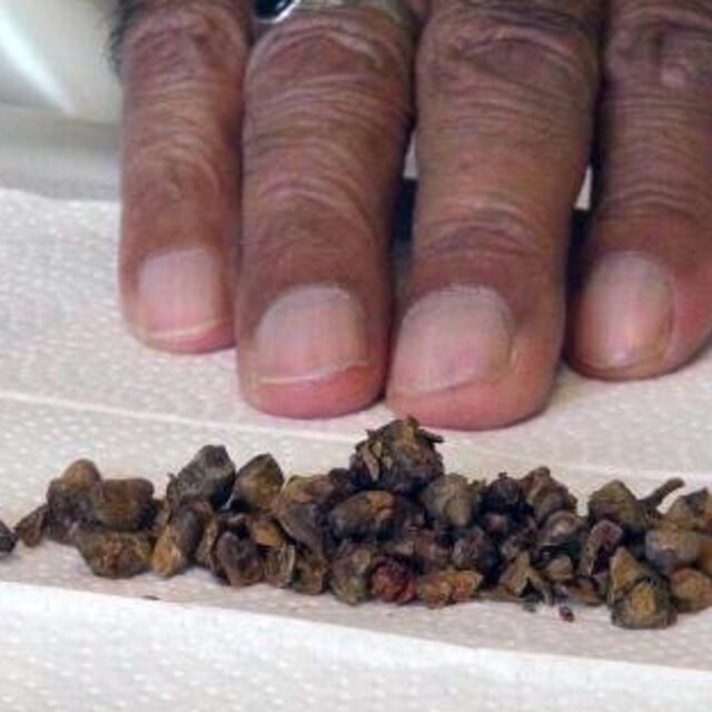 İdrar yollarından 120 taş çıkartıldı
