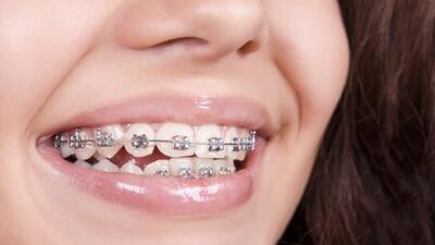 Diş teli kullanıyorsanız Ramazan'da dikkat!