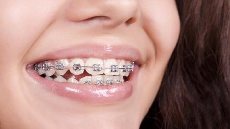 Diş teli kullanıyorsanız Ramazan'da dikkat!