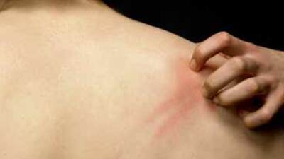 Erken tanı sedef hastalığını önleyebiliyor!