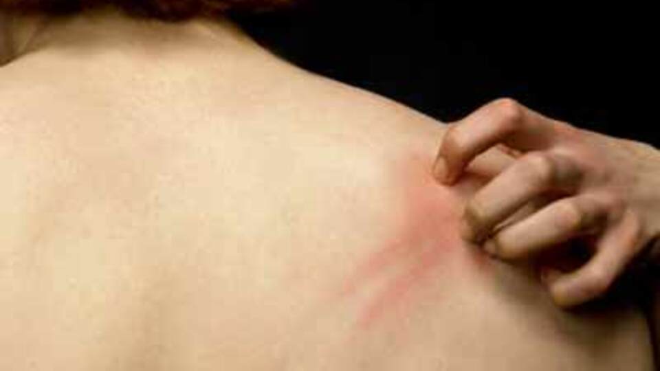 Erken tanı sedef hastalığını önleyebiliyor!