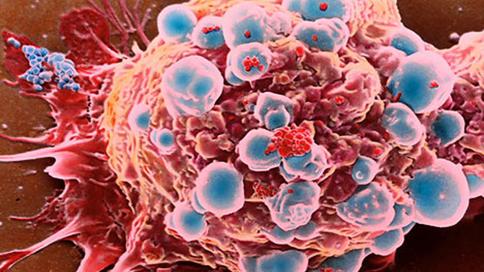 'Kanser yok edilemez'