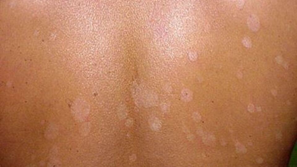 Bu lekeler kanser habercisi