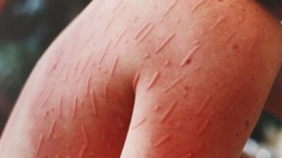 'Uyuz korkulacak bir hastalık değil'