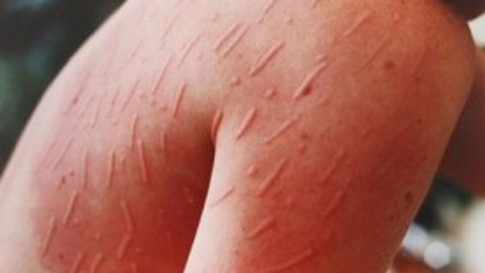 'Uyuz korkulacak bir hastalık değil'