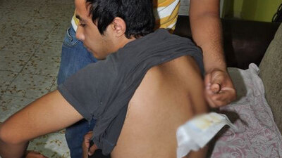 Sırtındaki cam parçası 2,5 ay sonra fark edildi