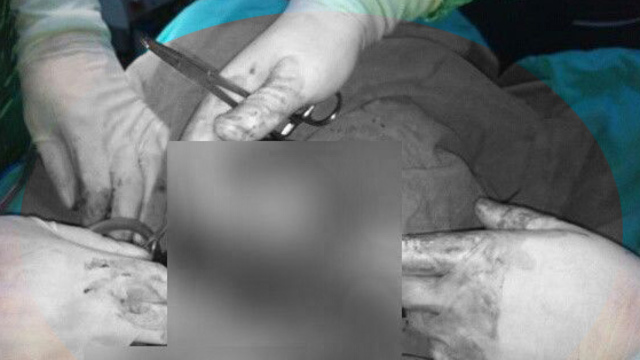 Böbreğinden 300 gram kist çıktı