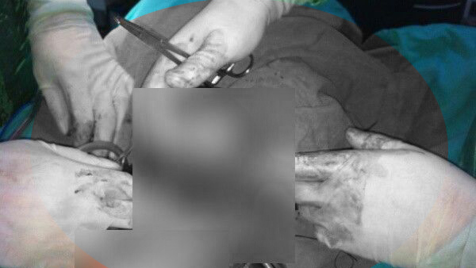 Böbreğinden 300 gram kist çıktı