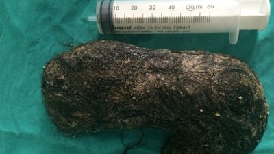 Yediği saç kılları midesinde yumak oldu