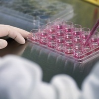 Beyin tümörü tedavisinde "kök hücre" umudu