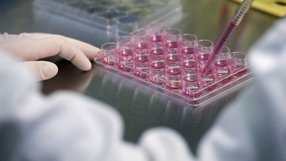 Beyin tümörü tedavisinde "kök hücre" umudu