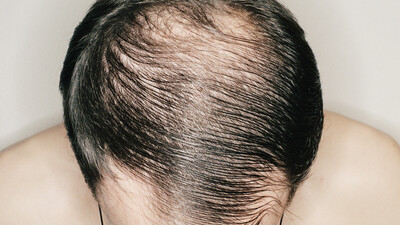 Kelliği sonbaharda durdurun