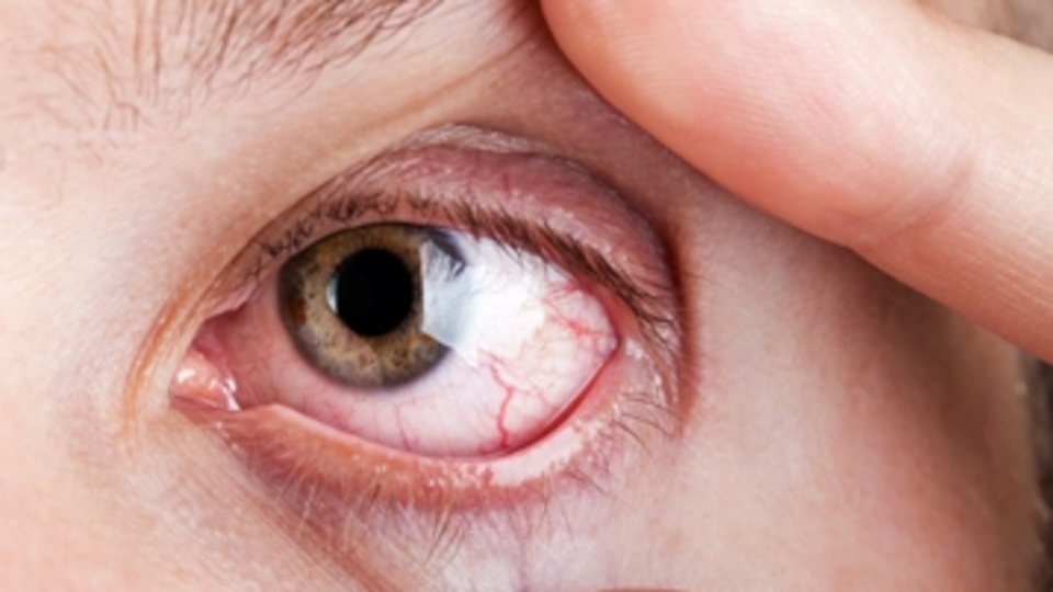 Behçet hastalığı en sık Türkiye'de görülüyor