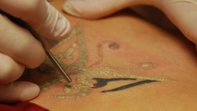 Dövmelerin silinmesi dermatolog gözetiminde yapılmalı