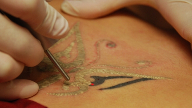 Dövmelerin silinmesi dermatolog gözetiminde yapılmalı