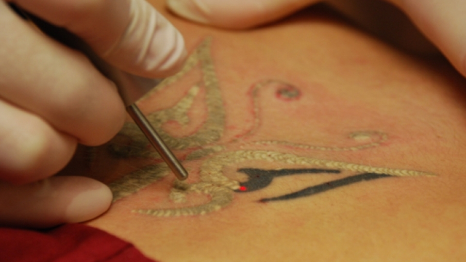 Dövmelerin silinmesi dermatolog gözetiminde yapılmalı
