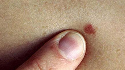 Kırmızı ben deyip geçmeyin!