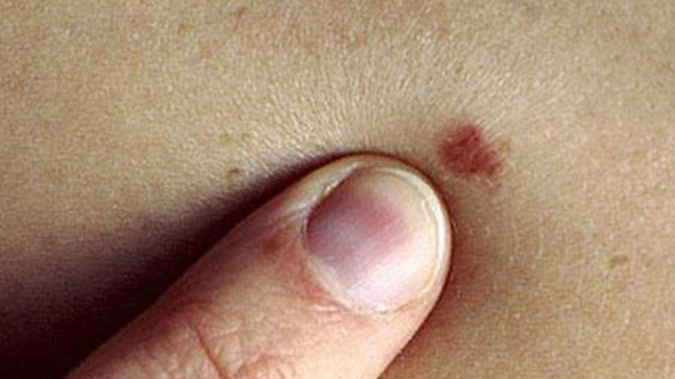 Kırmızı ben deyip geçmeyin!