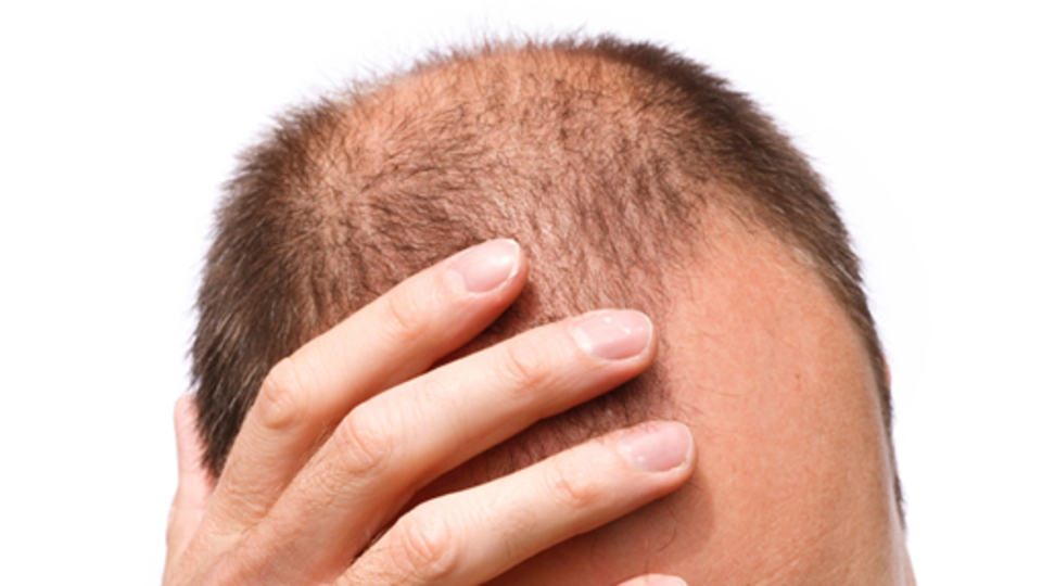 20'li yaşlardaki gençler seyrelmiş saçlarla yaşıyor