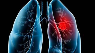 Akciğer kanseri önlenebiliyor