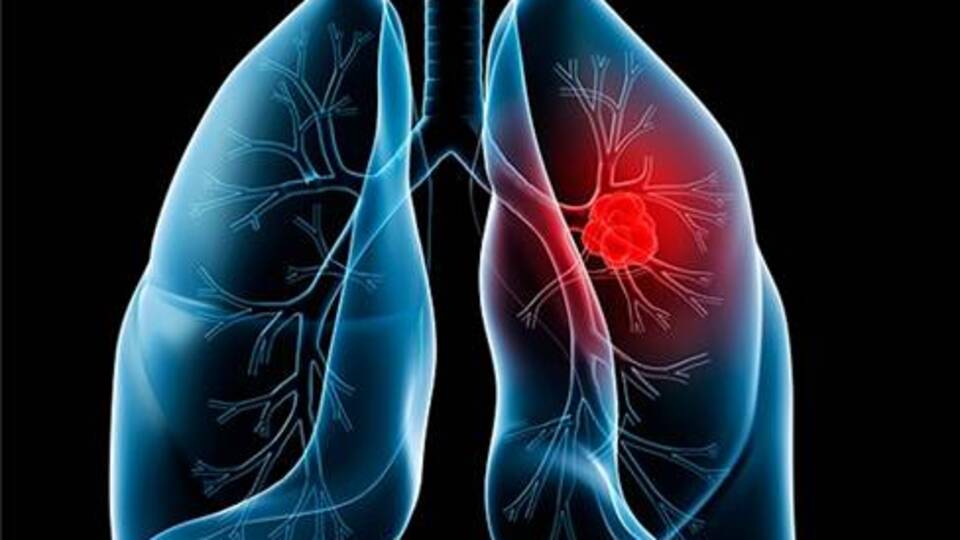 Akciğer kanseri önlenebiliyor