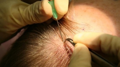 Saç ektirmeyi mi düşünüyorsunuz?