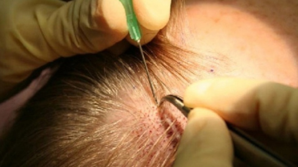 Saç ektirmeyi mi düşünüyorsunuz?