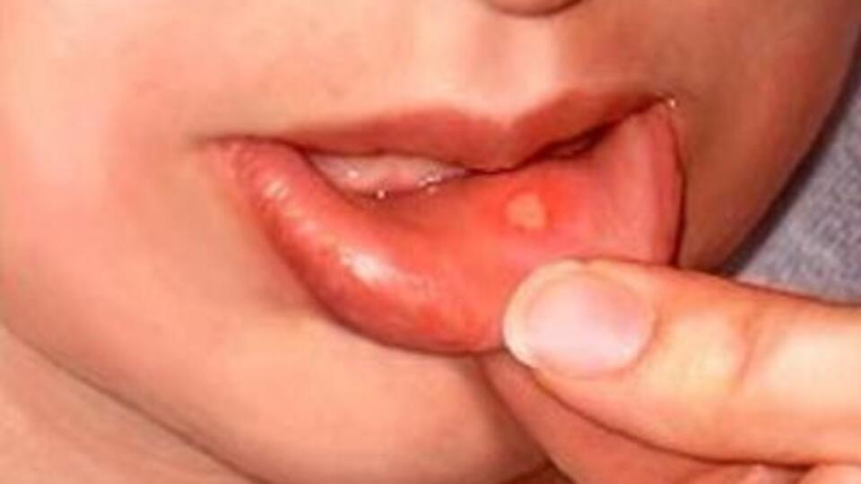 Ağız içindeki yaralara dikkat!