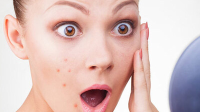 Her yaşın problemi: Sivilce