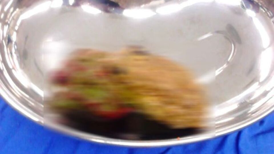 Midesinden 18 santimetrelik taş çıkartıldı