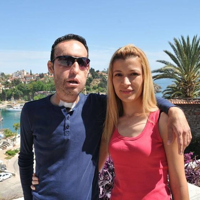 Yüz nakli olan Recep Sert evleniyor