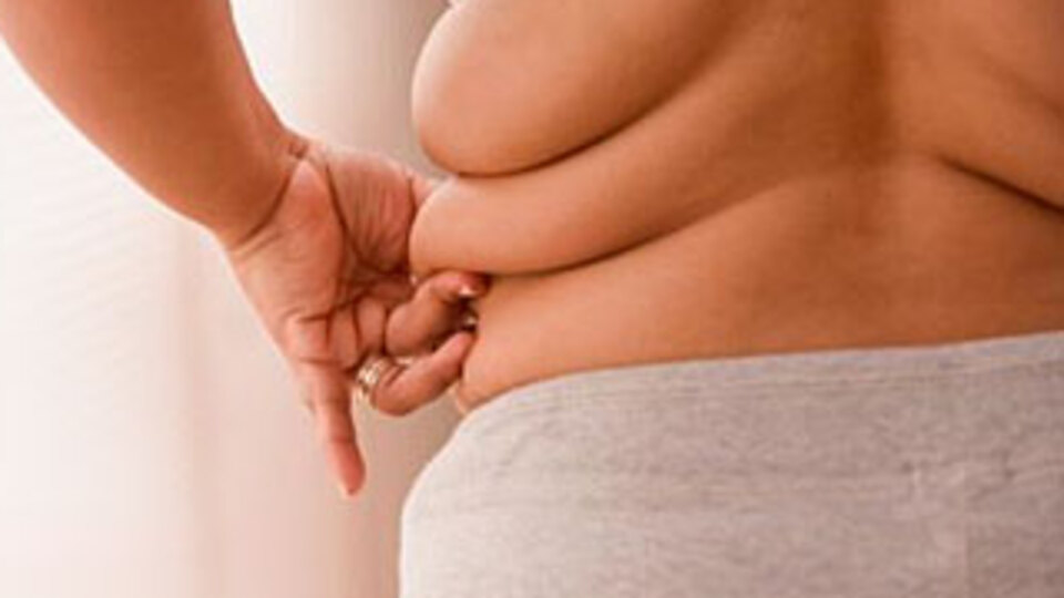 "Obezite'de ilk seçenek ameliyat değil"