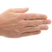 Sedef hastalığı ruh sağlığını da etkiliyor