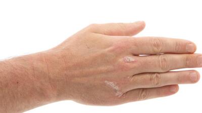 Sedef hastalığı ruh sağlığını da etkiliyor