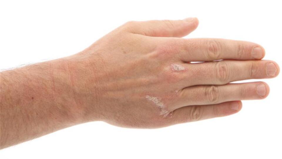 Sedef hastalığı ruh sağlığını da etkiliyor