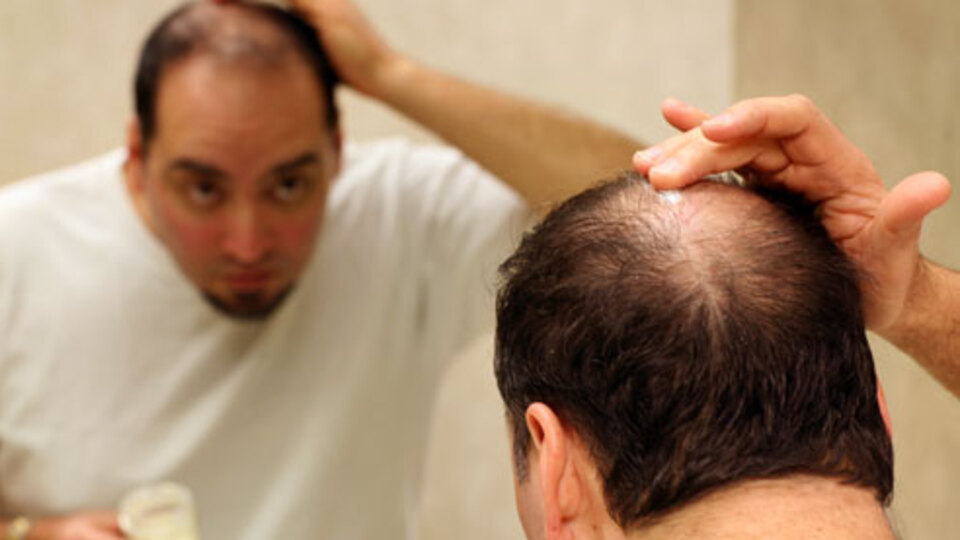 Saç kaybında "mucize tedaviler"e dikkat!